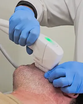 Tratamento Ultrassom Microfocado HIFU